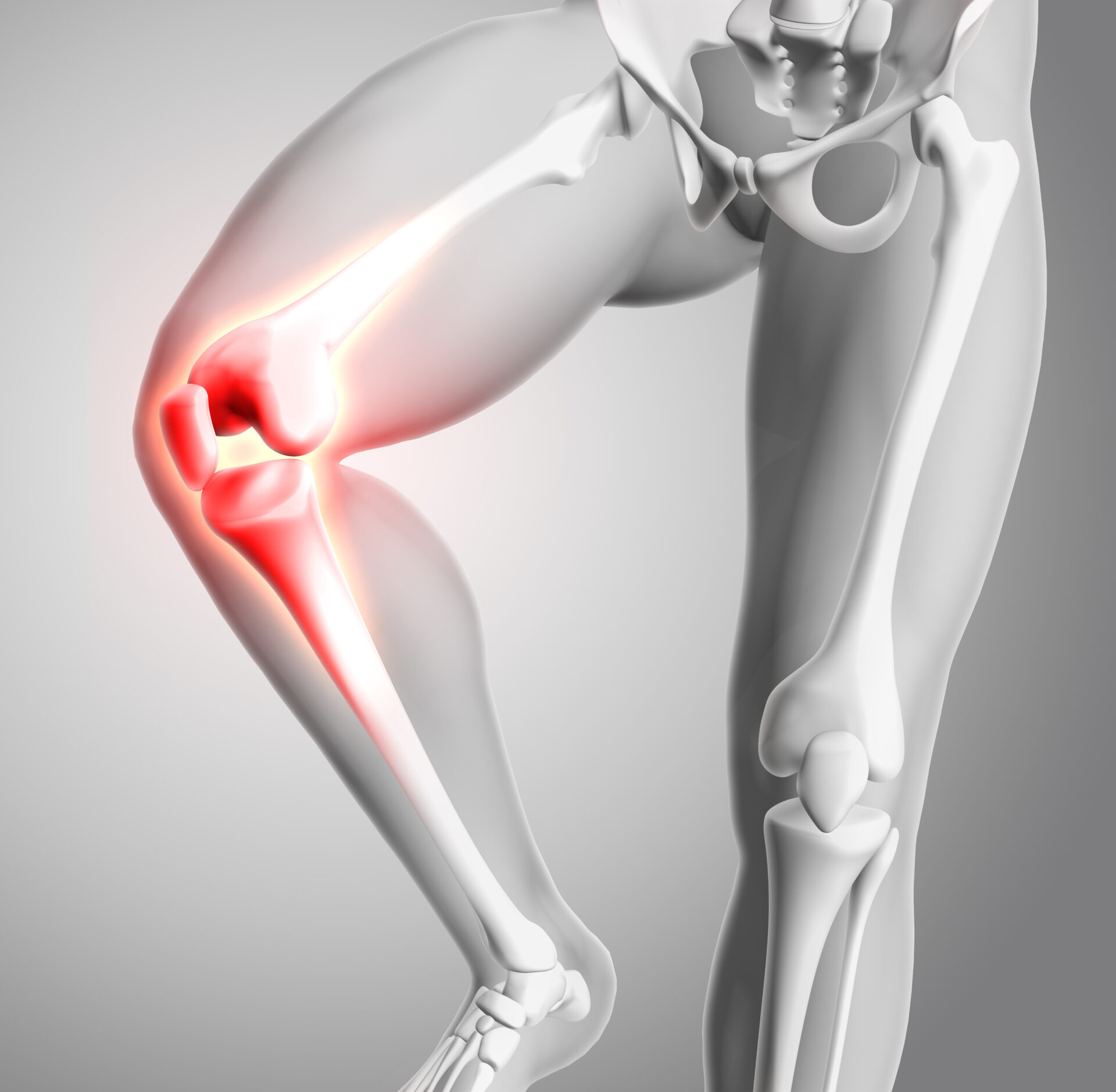 knee sprain